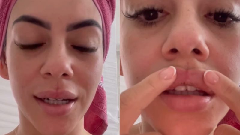 Vídeo: Após tratamento, Kaline Milena que foi agredida por cantor diz que tem corpo estranho nos lábios